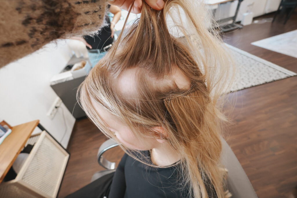 alopeetsia
