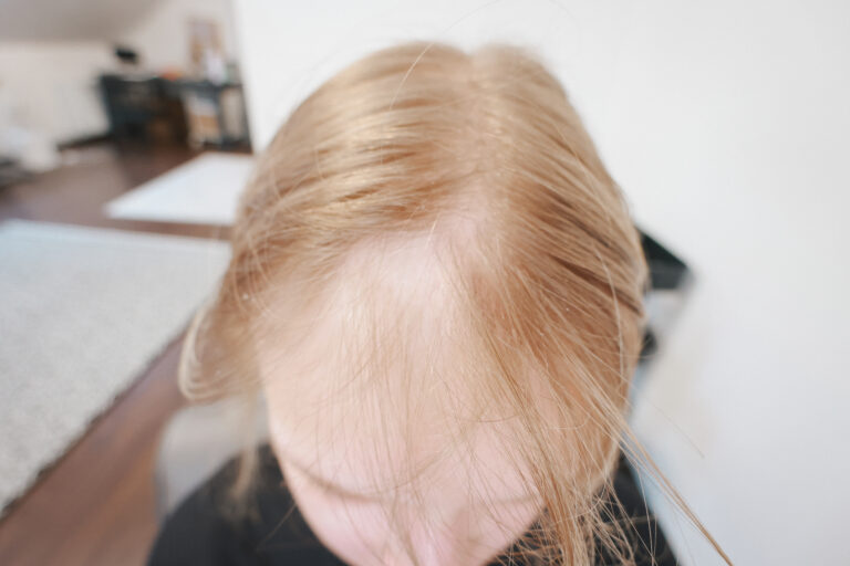 alopeetsia